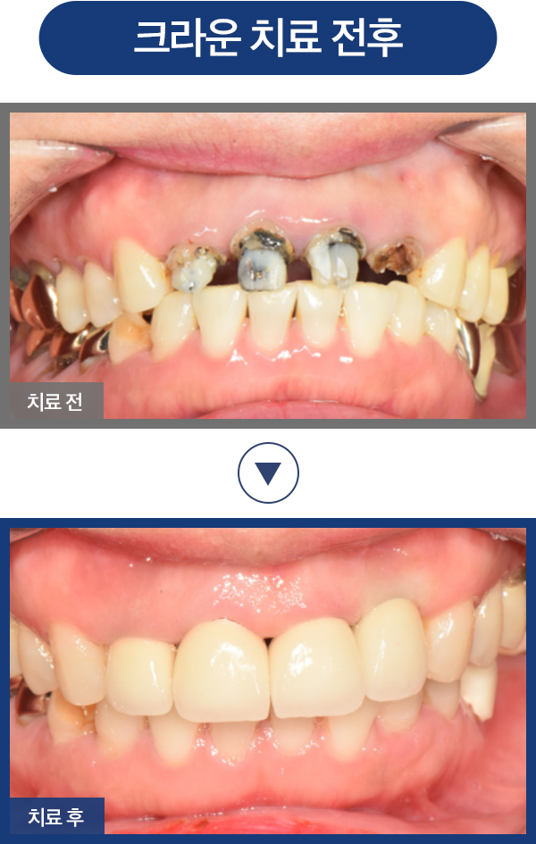 자연치아 살리기 증례01