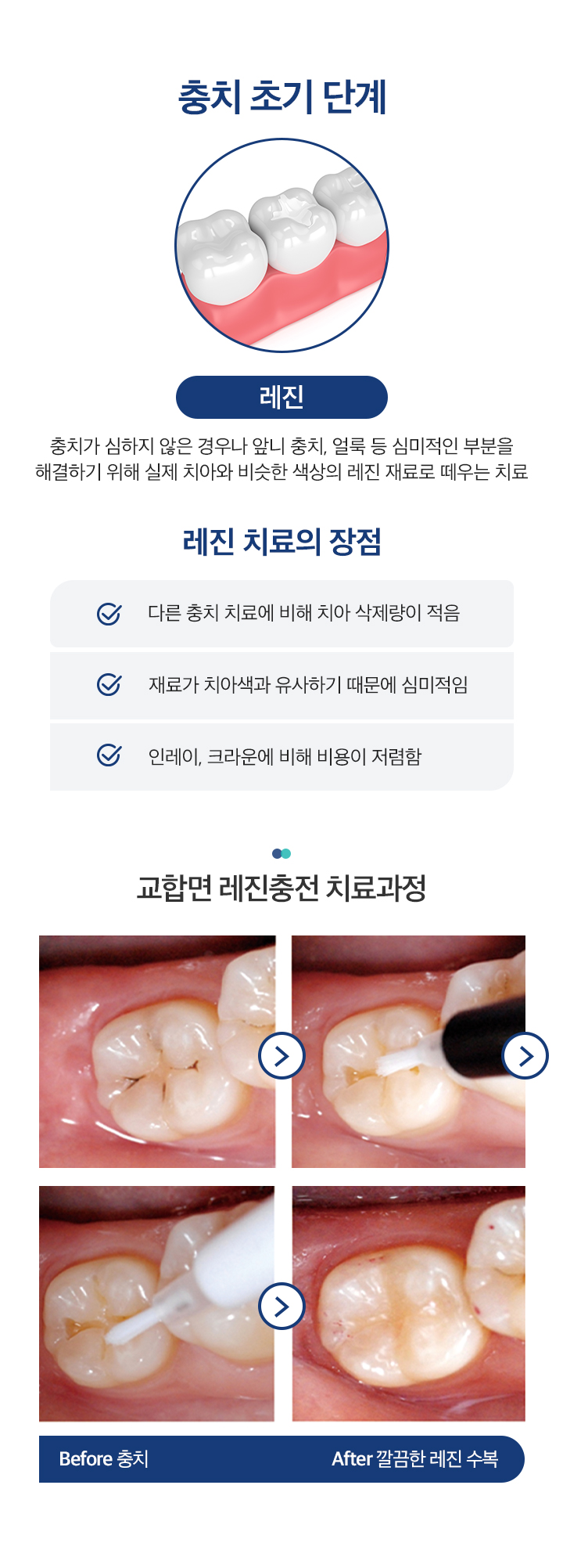 충치치료