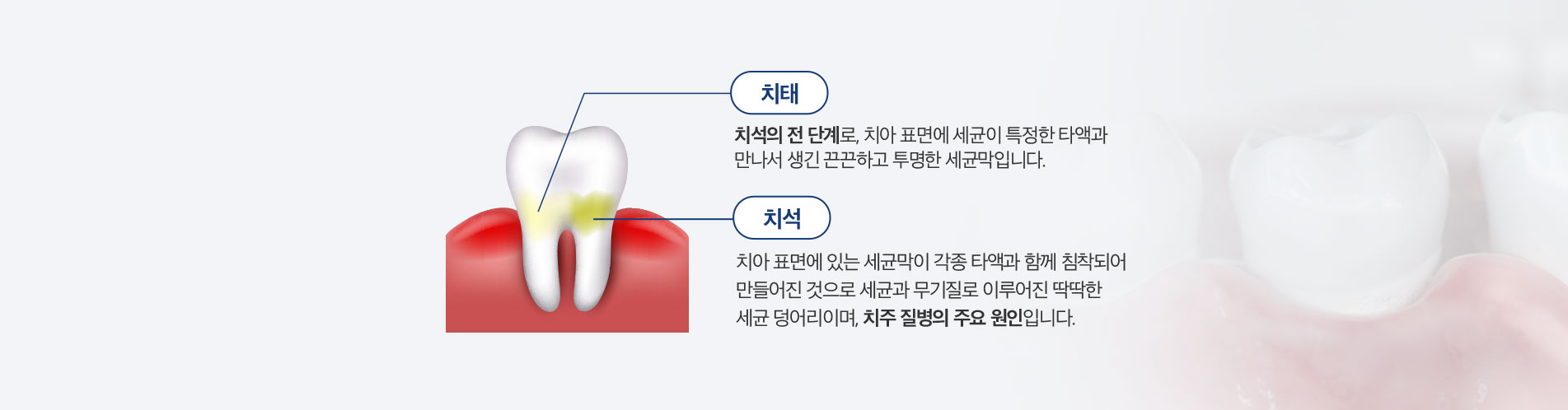잇몸치료
