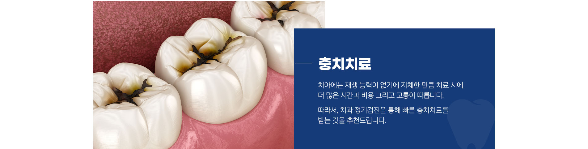 충치치료