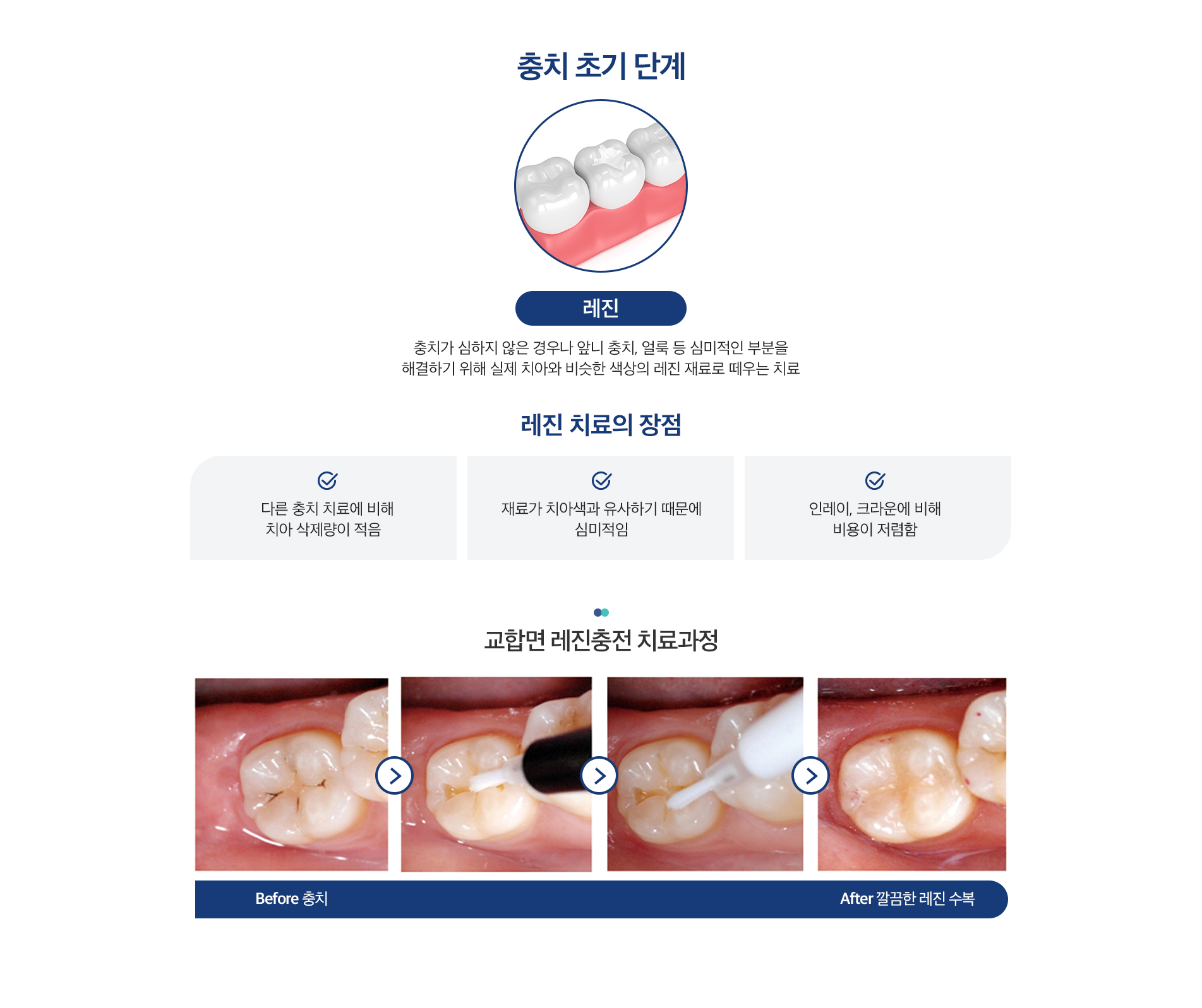 충치치료