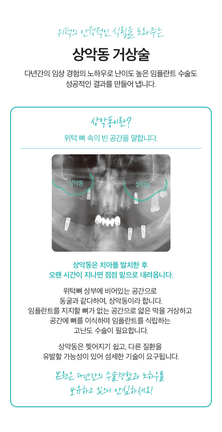 위턱의 안정적인 식립을 도와주는 상악동 거상술